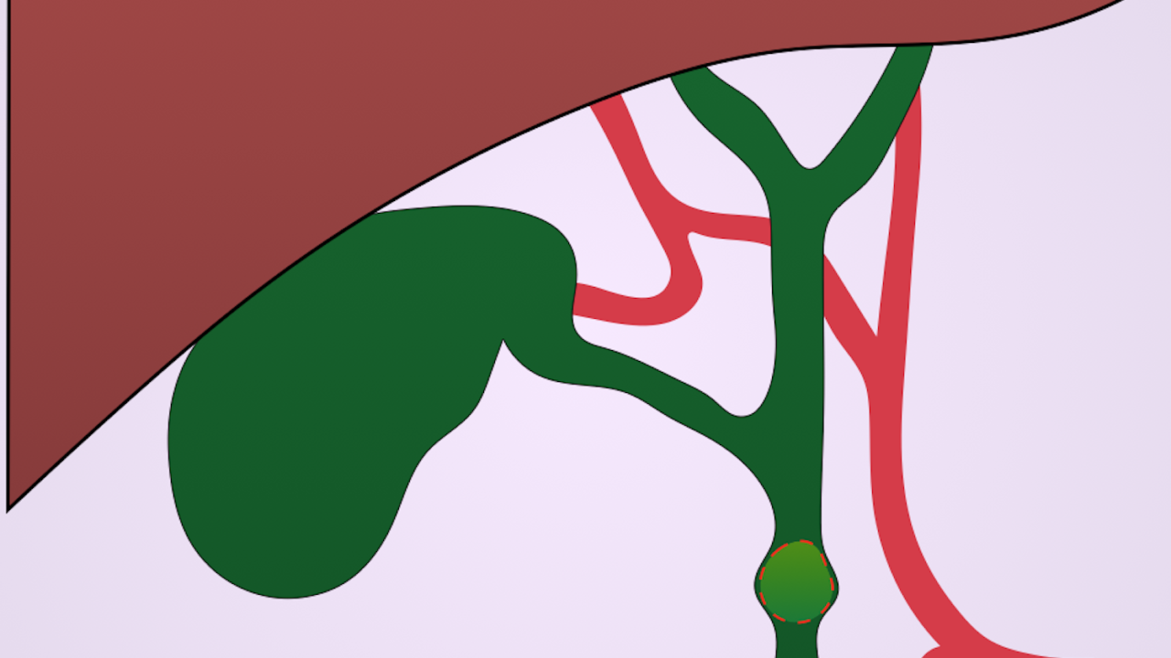 Choledocholithiasis