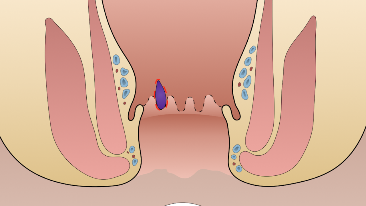 Hemorrhoidectomy