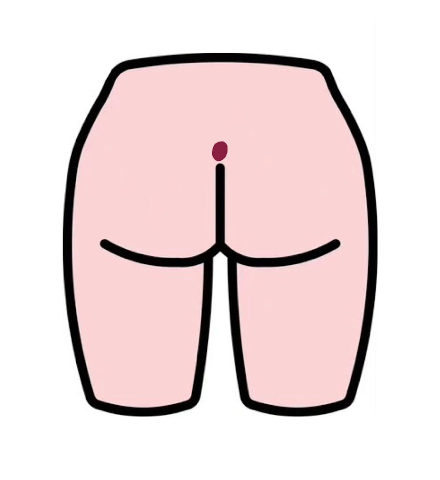 Pilonidal Cyst – SURGERY STUDENT