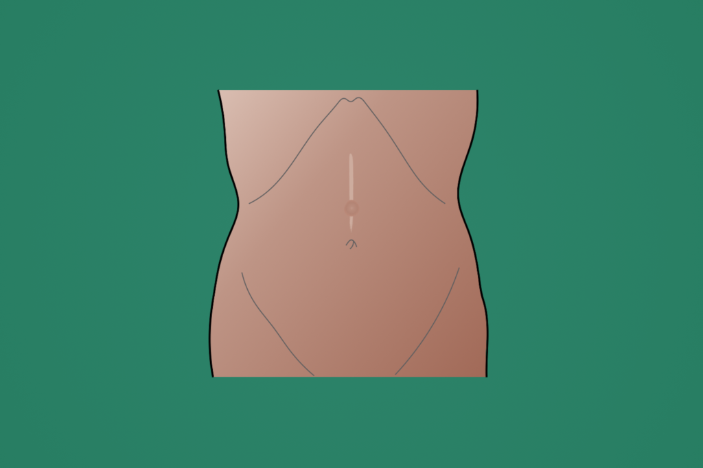 Ventral hernia surgery student