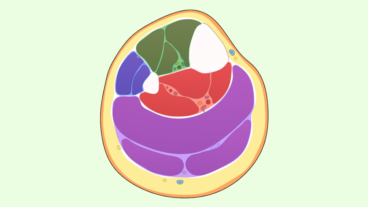 Acute Compartment Syndrome, leg