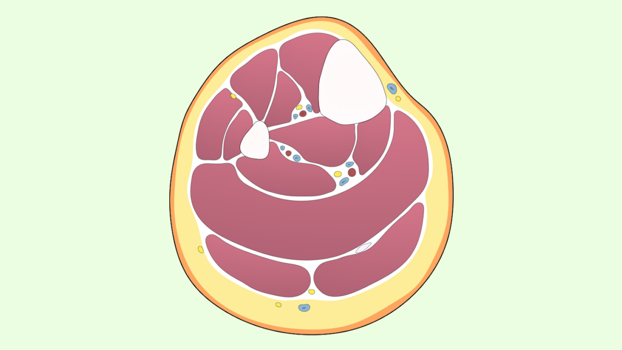 Fasciotomy, leg