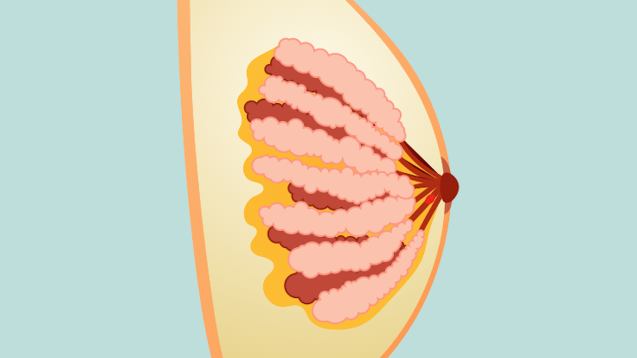 Intraductal Papilloma