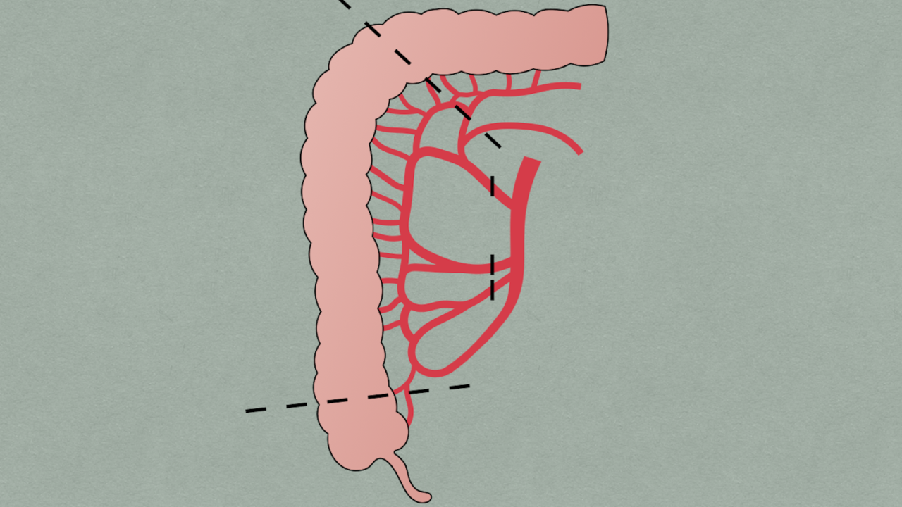 Colectomy, right laparoscopic