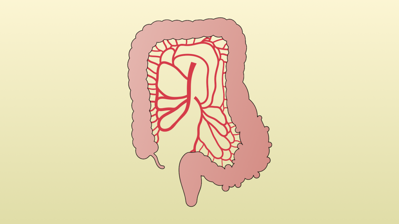 Diverticulosis