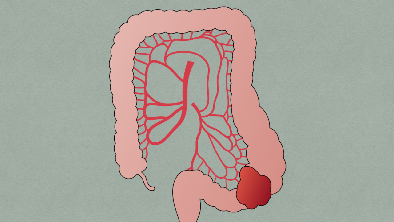 Large Bowel Obstruction