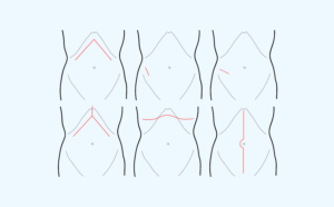 Axillary Incision Types Surgical Incisions – SURGERY STUDENT