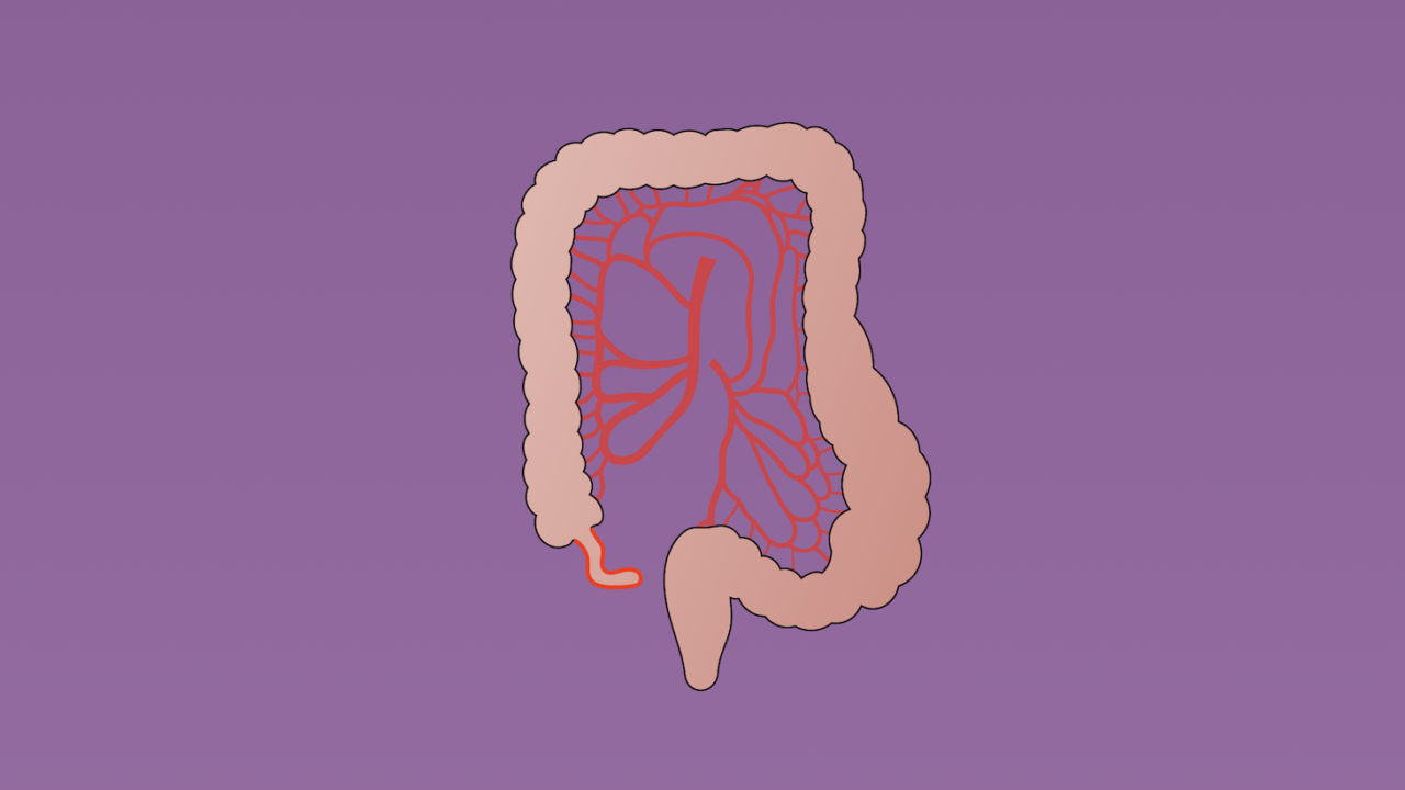 Appendiceal Carcinoma
