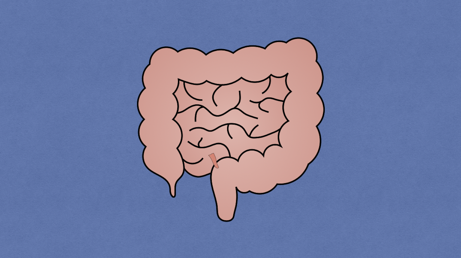Meckel Diverticulum