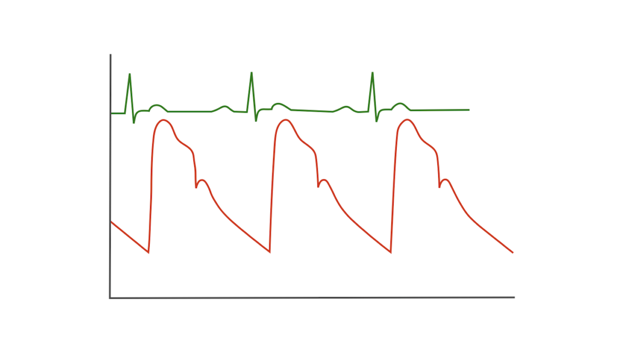 Arterial Line Insertion