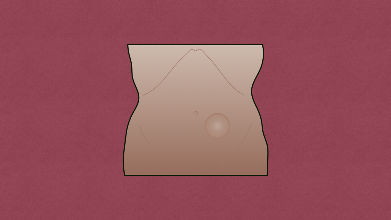 Rectus Sheath Hematoma