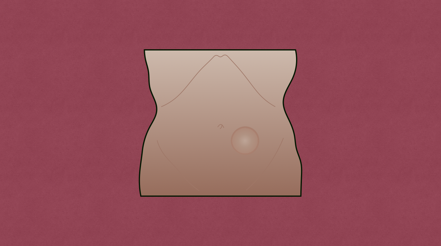 Rectus Sheath Hematoma