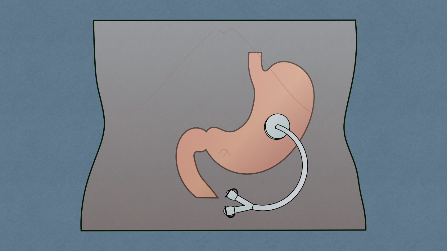 Gastrostomy Tube