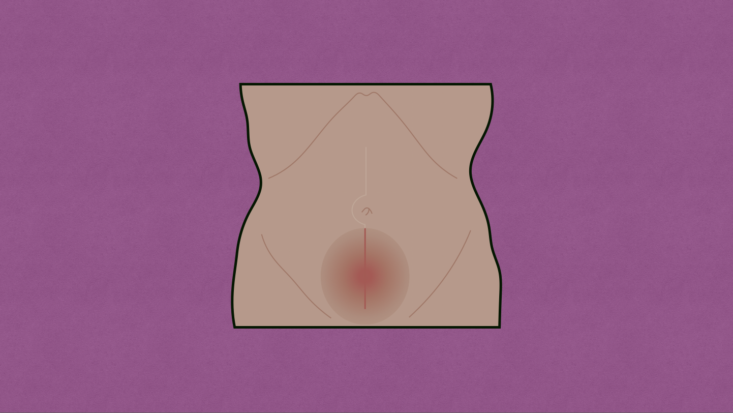 Surgical Site Infection