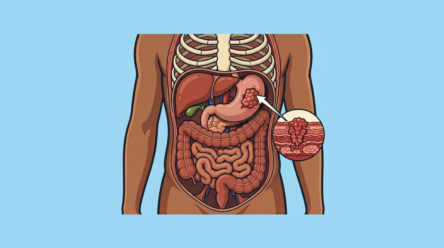 Gastric Adenocarcinoma