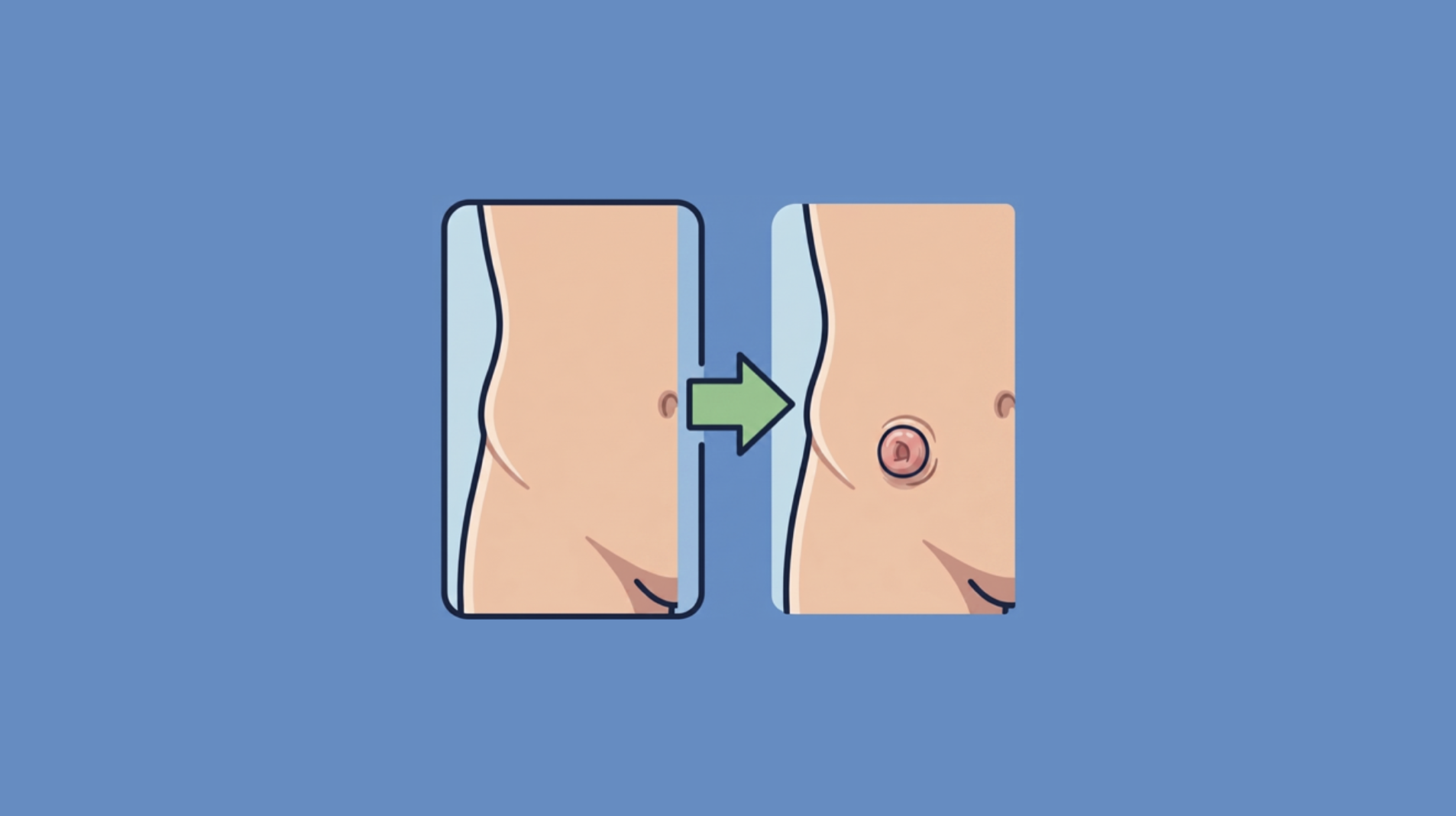 Ileostomy Creation