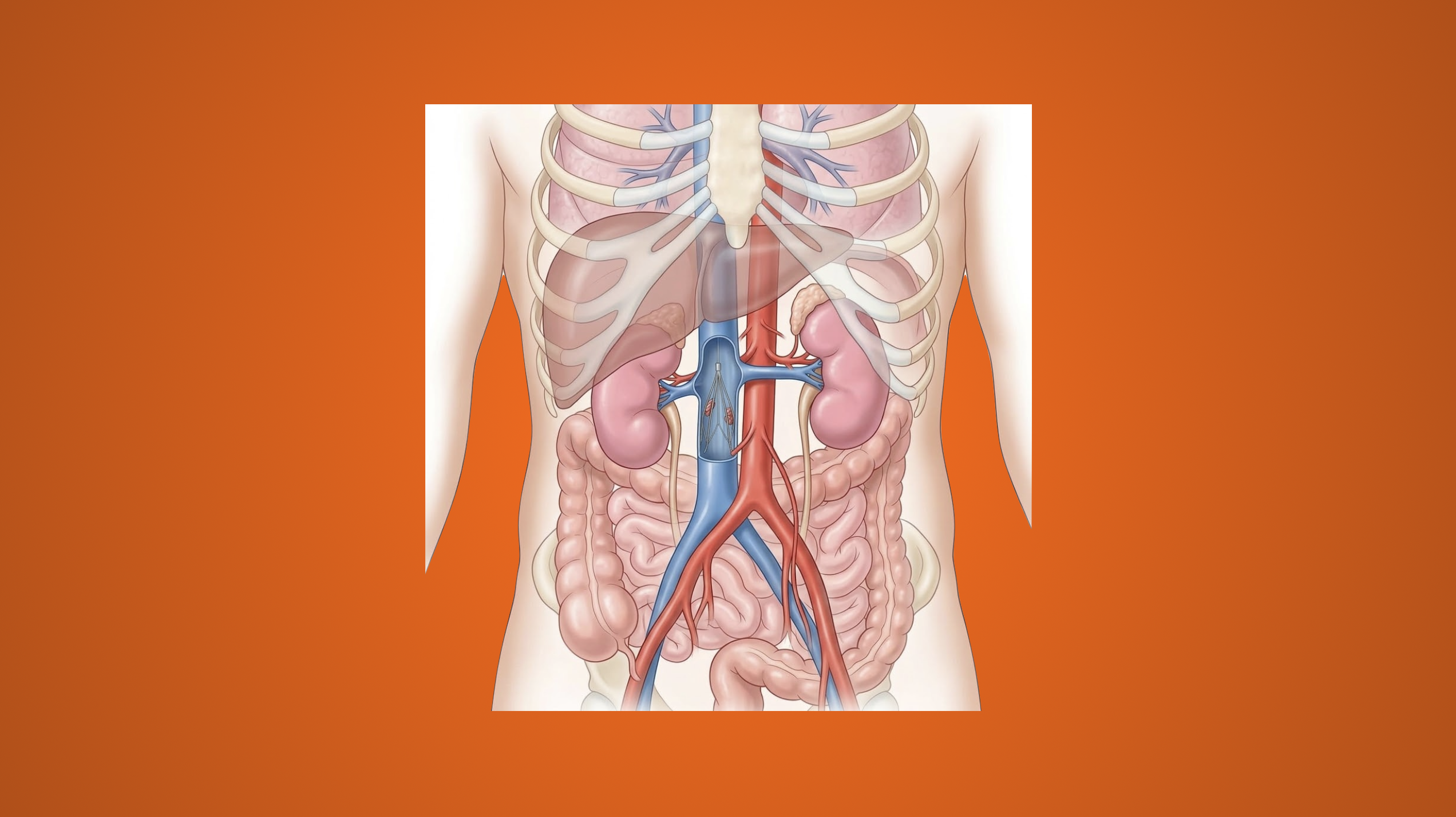 Vena Cava Filters